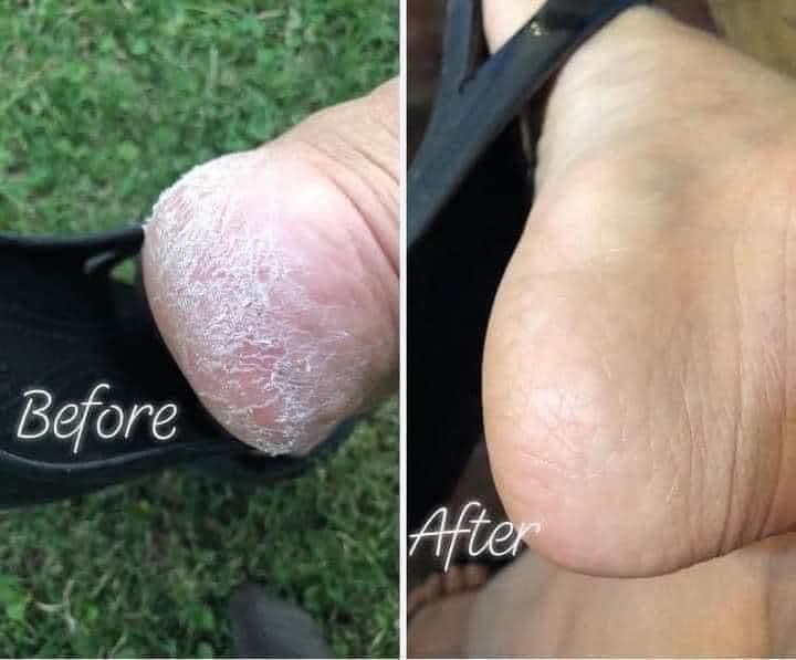 Foot Treatment Solution